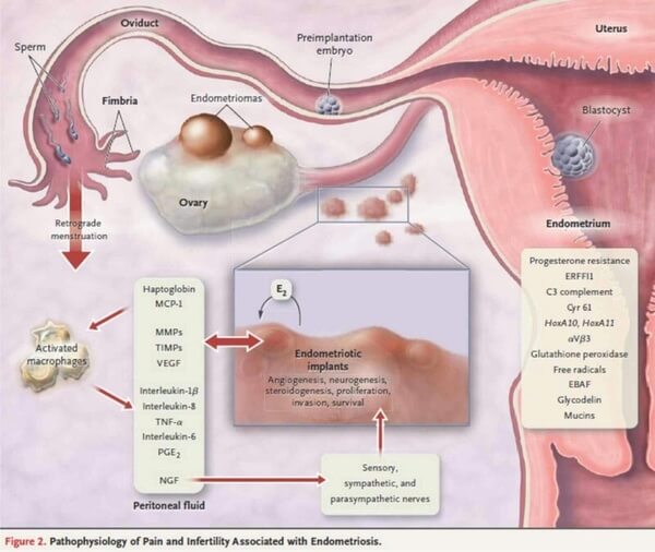 Endometriosi-anteprima-600x506-911980