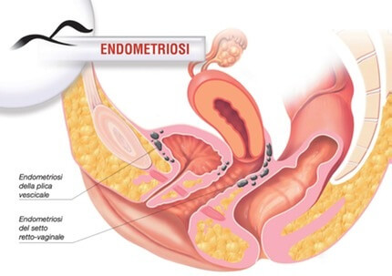 endometriosi_med_med_hr