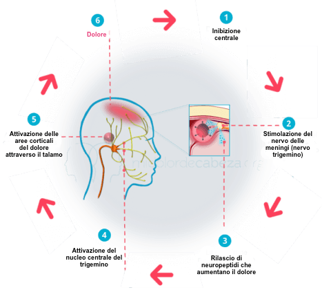 Cause del dolore delle emicranie