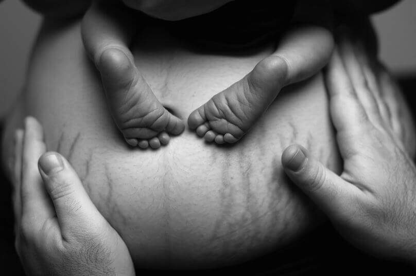 ventre-con-smagliature