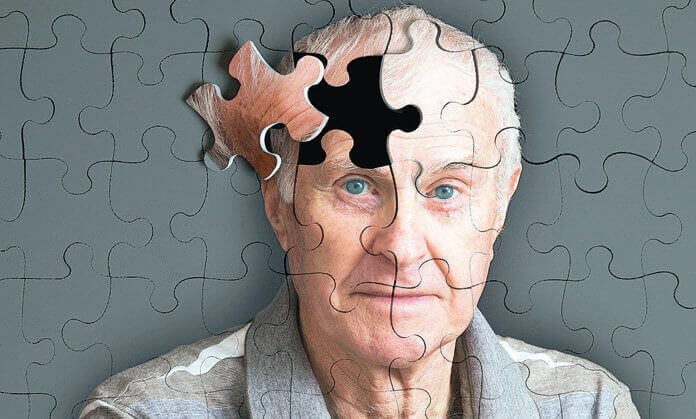 5 sintomi che precedono l'Alzheimer