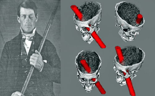 Incidente Phineas Gage