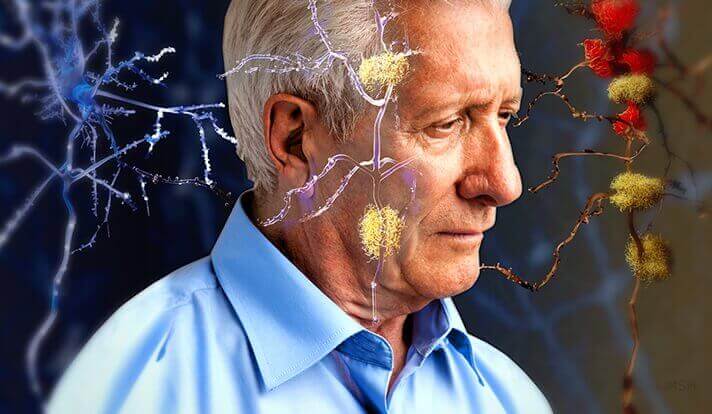 Anziano con Alzheimer