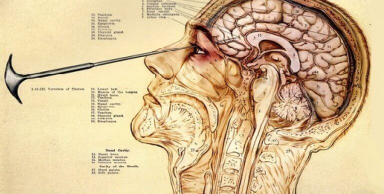 Lobotomia transorbitale