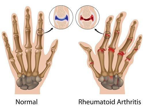 Confronto mano normale o con artrite reumatoide