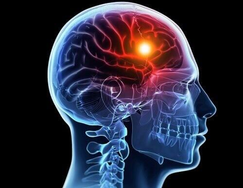 Accidenti cerebrovascolari: cause e tipi