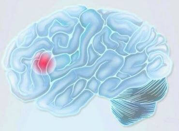cervello con punto rosso a rappresentare l'ictus