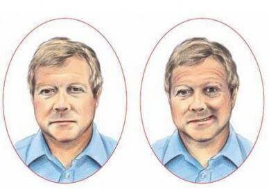 Viso normale e viso colpito da ictus a confronto