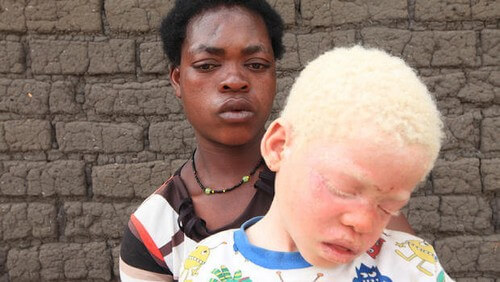 Bambino albino con la madre