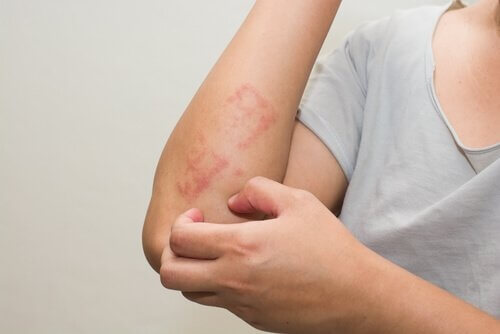Dermatite atopica, 6 consigli per trattarla