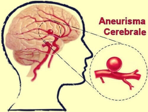 Aneurisma cerebrale: definizione, sintomi, trattamenti
