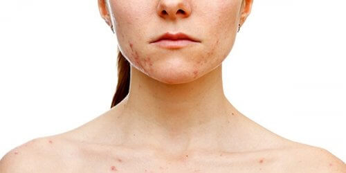 Ragazza con acne diffusa sul viso a causa della sindrome dell'ovaio policistico