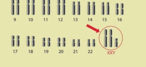 Anomalia dei cromosomi sessuali.