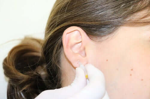 Applicazione di un micro-impianto nell'orecchio.