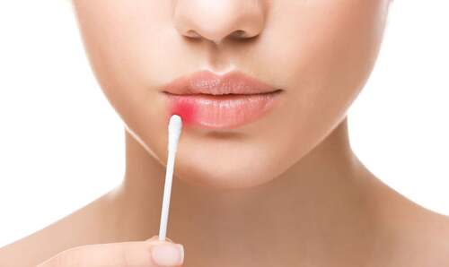 Donna che applica una crema anti herpes.