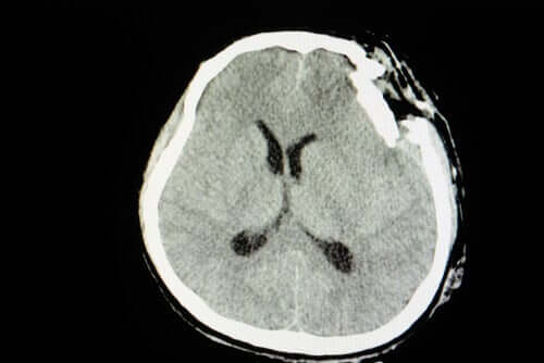 Radiografia del cervello che mostra un trauma cranico.