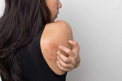 Donna con orticaria sulle spalle.