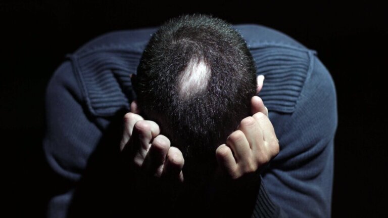 Alopecia areata e stress: come sono correlati
